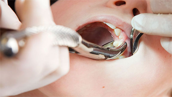 Dental extraction in Iran