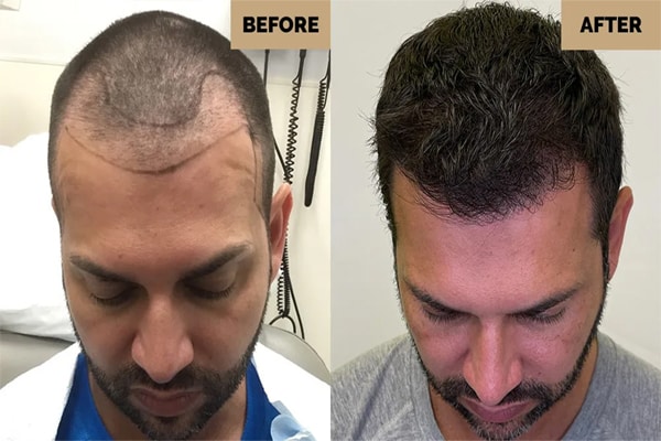 Selecting the best doctor and hair transplant clinic in Iran
