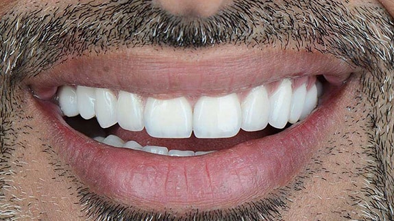 Hollywood smile in Iran