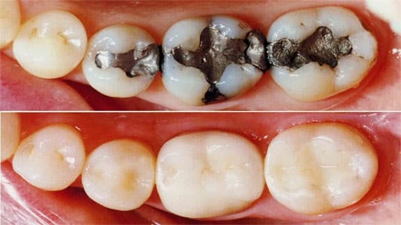 Dental restoration in Iran