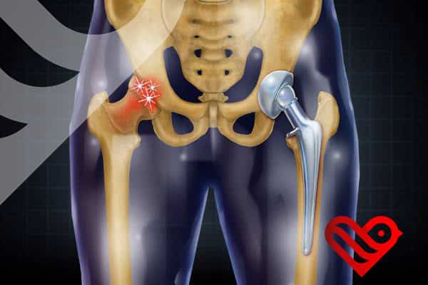 Benefits of Hip Replacement Surgery in Iran