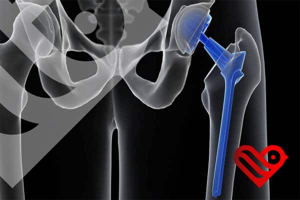 Disadvantages of Hip Replacement Surgery in Iran
