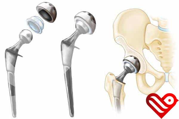 Hip Replacement Surgery Risks