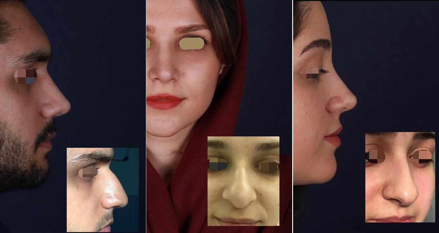 Iranian nose job before and after photos