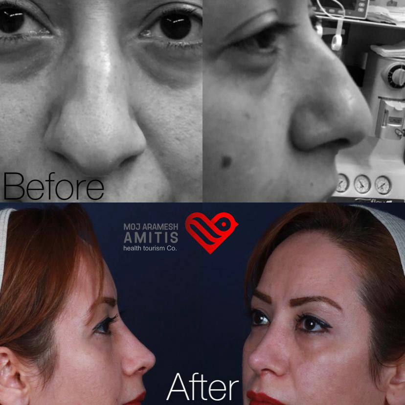 Natural style for fleshy noses rhinoplasty in Iran