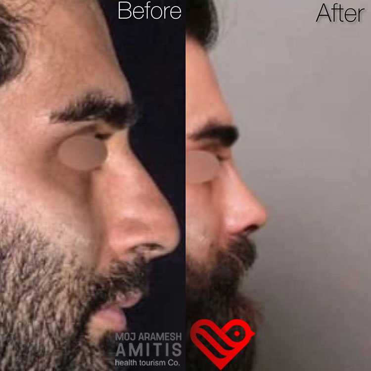  Open vs Closed Rhinoplasty which one is better