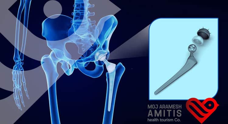 Post-operative Hip Replacement Surgery