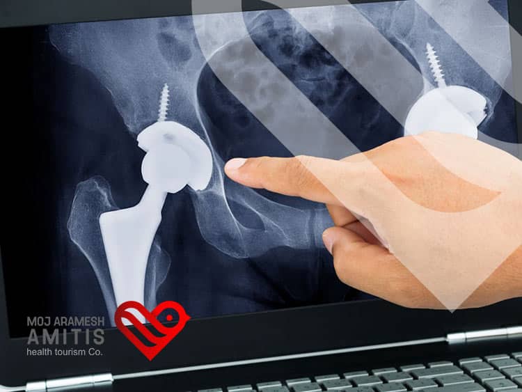 Types of Hip Replacement Surgeries in Iran