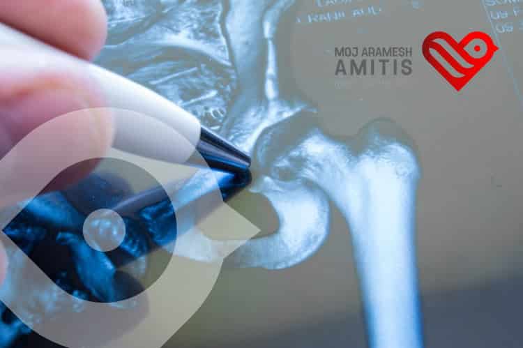 What is Hip Replacement PROCEDURE in Iran